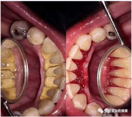 孕期牙齿出血正常吗(来月经牙齿出血是什么原因) 第2张 孕期牙齿出血正常吗(来月经牙齿出血是什么原因) 第2张