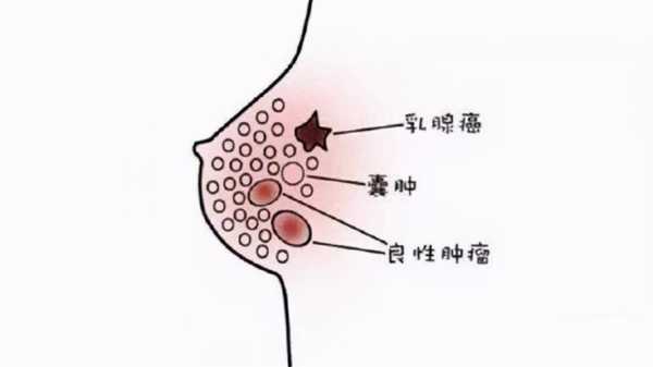 孕期乳房纤维瘤(孕期乳房纤维瘤变大怎么办) 第2张 孕期乳房纤维瘤(孕期乳房纤维瘤变大怎么办) 第2张