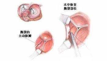 胎儿主动脉偏细吃什么(胎儿主动脉偏细吃什么长得快) 第2张 胎儿主动脉偏细吃什么(胎儿主动脉偏细吃什么长得快) 第2张