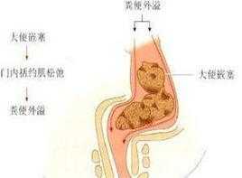 孕期用力大便阴唇肿大(孕妇用力大便阴嘴膨出躺着能恢复吗) 第2张 孕期用力大便阴唇肿大(孕妇用力大便阴嘴膨出躺着能恢复吗) 第2张