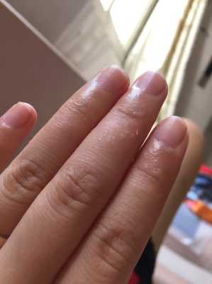 孕期手上长小水泡(孕晚期手上脚上长了许多小水泡咋回事啊) 第1张 孕期手上长小水泡(孕晚期手上脚上长了许多小水泡咋回事啊) 第1张