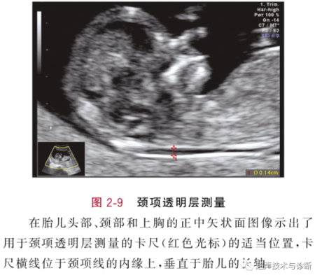 胎儿颈部可见u形压迹(怀孕37周胎儿检查颈项可见u型压迹是什么意思) 第2张 胎儿颈部可见u形压迹(怀孕37周胎儿检查颈项可见u型压迹是什么意思) 第2张