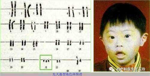胎儿怎样排除是唐氏儿(胎儿怎样排除是唐氏儿呢) 第1张 胎儿怎样排除是唐氏儿(胎儿怎样排除是唐氏儿呢) 第1张