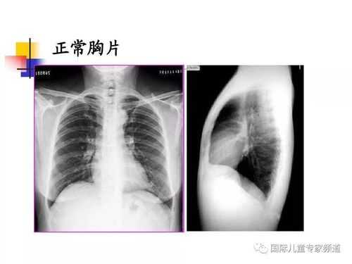 一次胸片不会影响胎儿(一次胸片不会影响胎儿) 第1张 一次胸片不会影响胎儿(一次胸片不会影响胎儿) 第1张