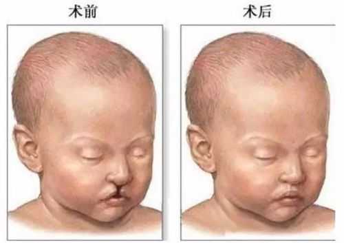 宝宝为什么会得裂唇,是遗传吗,胎儿裂唇是怎么形成的原因 第1张 宝宝为什么会得裂唇,是遗传吗,胎儿裂唇是怎么形成的原因 第1张