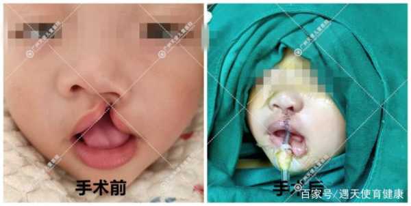 宝宝为什么会得裂唇,是遗传吗,胎儿裂唇是怎么形成的原因 第2张 宝宝为什么会得裂唇,是遗传吗,胎儿裂唇是怎么形成的原因 第2张