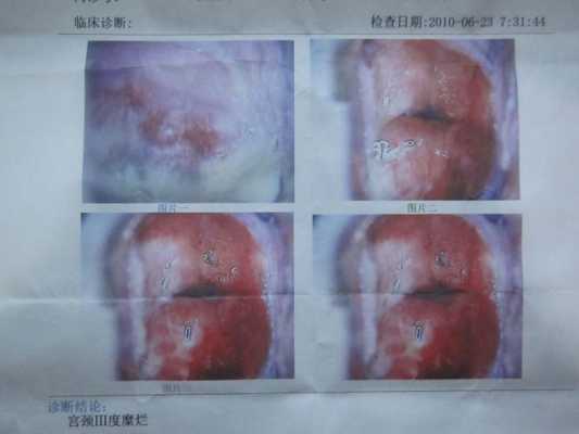 怀孕后期孕妇有宫颈糜烂可以治疗吗，怎么治,孕妇宫颈糜烂对胎儿有影响吗视频  第2张