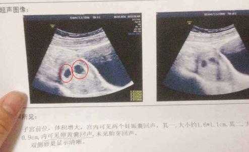 孕6周的胎儿多大才是正常,怀孕六周胎儿图看男女准吗 第3张 孕6周的胎儿多大才是正常,怀孕六周胎儿图看男女准吗 第3张