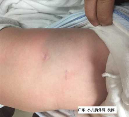 先天性肺囊腺瘤会变小吗,胎儿左肺囊腺瘤怎么办能治好吗 第1张 先天性肺囊腺瘤会变小吗,胎儿左肺囊腺瘤怎么办能治好吗 第1张