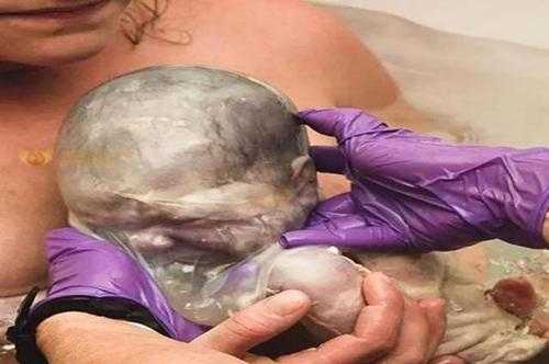 36周剖腹产胎儿的影响(36周剖腹产胎儿的影响) 第1张 36周剖腹产胎儿的影响(36周剖腹产胎儿的影响) 第1张