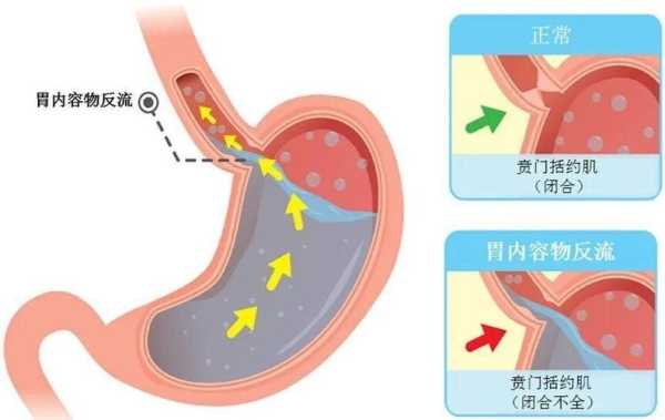孕期胃食管反流(孕期胃食管反流怎么缓解) 第1张 孕期胃食管反流(孕期胃食管反流怎么缓解) 第1张
