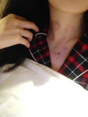 b超胎儿颈部见u型压痕(压痕和吻痕的区别) 第2张 b超胎儿颈部见u型压痕(压痕和吻痕的区别) 第2张