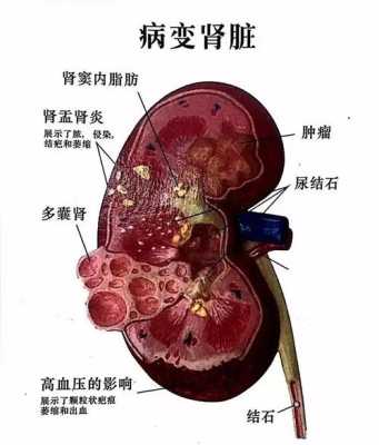 胎儿左肾双肾盂怎么办（胎儿左肾双肾盂有什么危害）  第1张