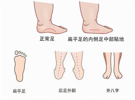 胎儿脚在右侧是男是女(一岁宝宝走路两只脚不一样) 第1张 胎儿脚在右侧是男是女(一岁宝宝走路两只脚不一样) 第1张