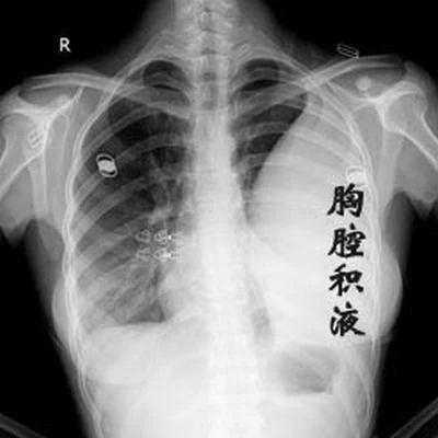 胎儿胸腔积水生下来了(胎儿胸腔积水生下来了) 第1张 胎儿胸腔积水生下来了(胎儿胸腔积水生下来了) 第1张