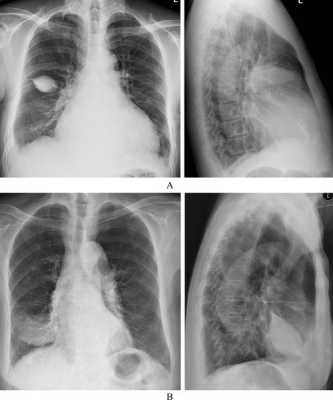 胎儿胸腔积水生下来了(胎儿胸腔积水生下来了) 第2张 胎儿胸腔积水生下来了(胎儿胸腔积水生下来了) 第2张