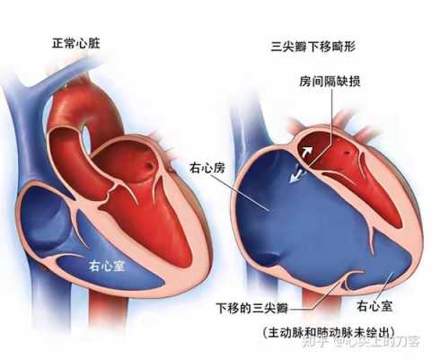 胎儿三尖瓣轻度返流孕妇要怎么办,胎儿三尖瓣大量反流可以生下来吗 第2张 胎儿三尖瓣轻度返流孕妇要怎么办,胎儿三尖瓣大量反流可以生下来吗 第2张