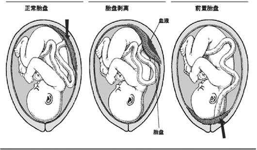 胎儿离宫颈口近的原因(胎儿离宫颈口近的原因) 第2张 胎儿离宫颈口近的原因(胎儿离宫颈口近的原因) 第2张