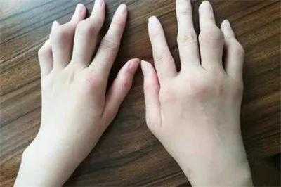 孕期手指关节疼(孕期手指关节疼是什么原因造成的) 第1张 孕期手指关节疼(孕期手指关节疼是什么原因造成的) 第1张