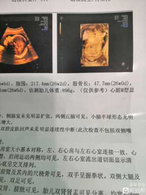 四维彩超查出宝宝肾有积水怎么办,四维彩超胎儿肾盂正常范围 第1张 四维彩超查出宝宝肾有积水怎么办,四维彩超胎儿肾盂正常范围 第1张